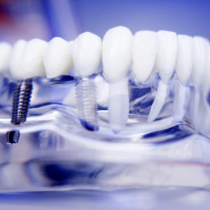 Implantologia - Studio dentistico Di Caprio
