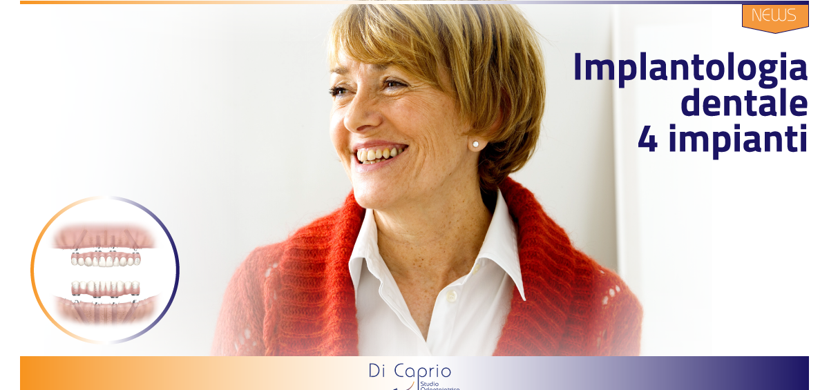 Implantologia su 4 impianti | Dentista a Vairano Scalo | Studio Dentistico Di Caprio|