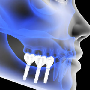 Implantologia computer guidata | Studio Dentistico Di Caprio | Dentista a Vairano Scalo